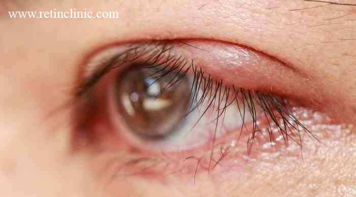 درمان ورم پلک چشم