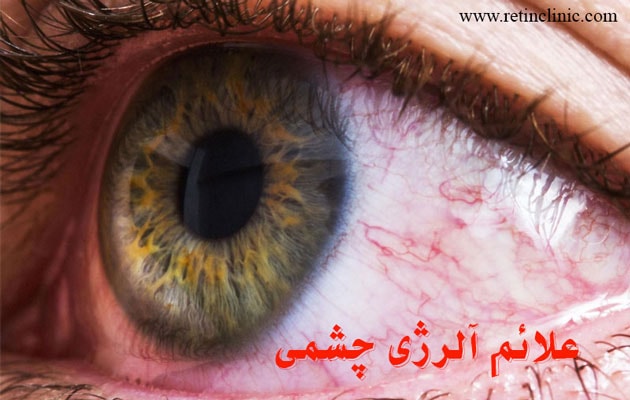 علائم آلرژی چشمی