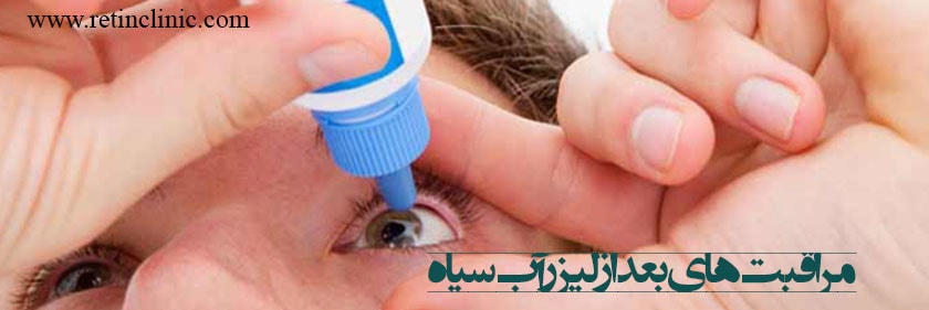 مراقبت های بعد از لیزر آب سیاه چشم