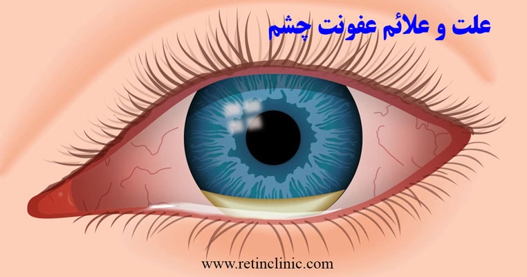 علت و علائم عفونت چشم