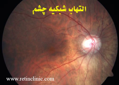 التهاب شبکیه چشم