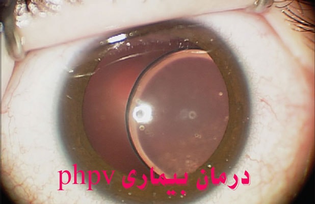 درمان بیماری چشمی PHPV