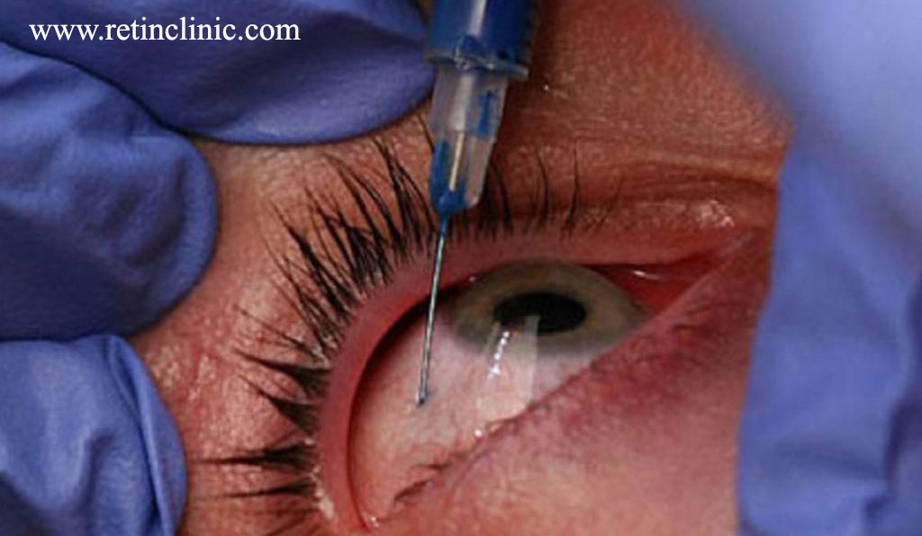 تزریق روغن داخل چشم