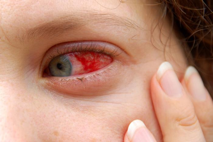 درمان مشکل لکه خون در چشم