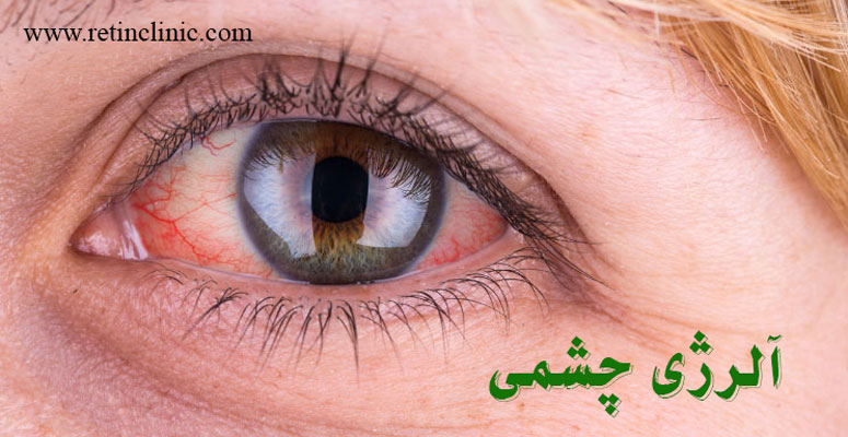 آلرژی چشمی