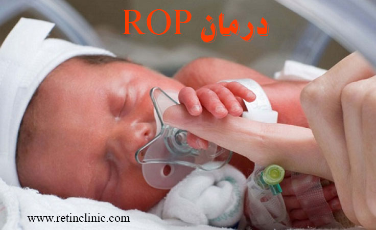 درمان رتینوپاتی نوزادان نارس(ROP)