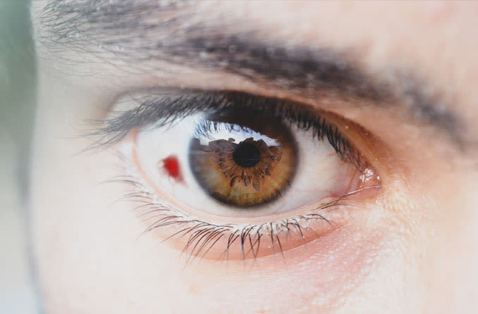 علل ایجاد لکه خون در چشم