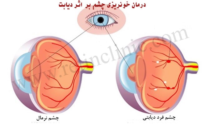 درمان خونریزی چشم بر اثر دیابت