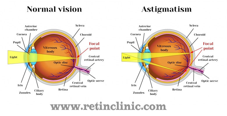 عمل لیزیک چشم آستیگمات چگونه انجام می‌شود