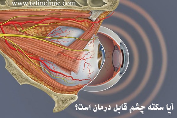 آیا سکته چشمی قابل درمان است؟