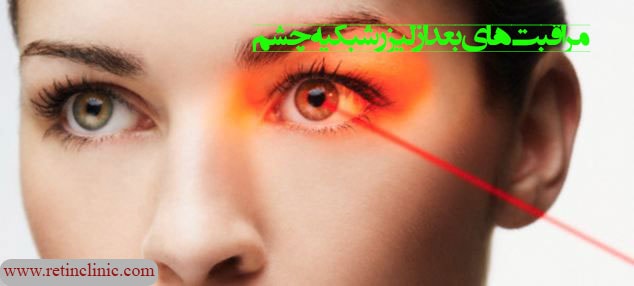 مراقبت‌های بعد از لیزر شبکیه چشم
