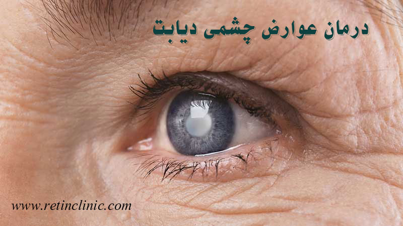عوارض چشمی دیابت