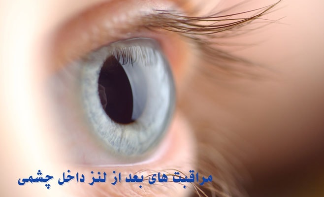 مراقبت های بعد از عمل لنز داخل چشمی