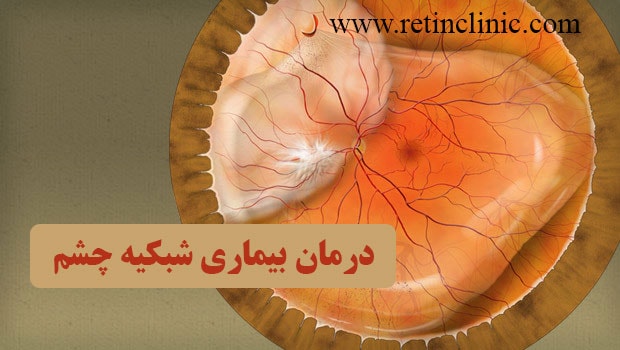 بیماری مادرزادی شبکیه چشم