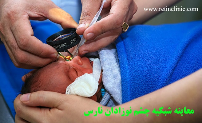 معاینه شبکیه چشم نوزادان نارس