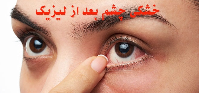 خشکی چشم بعد از لیزیک چشم