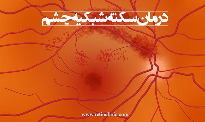 درمان سکته شبکیه چشم