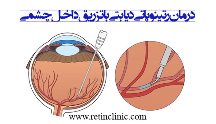درمان رتینوپاتی دیابتی با تزریق داخل چشمی